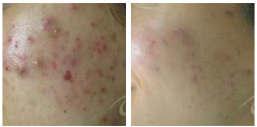 The Bin Pimple Cream and Facewash Combo : Magical Pimple Removal Cream That Makes Acne Disappear!