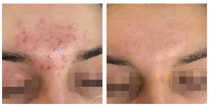 The Bin Pimple Cream and Facewash Combo : Magical Pimple Removal Cream That Makes Acne Disappear!