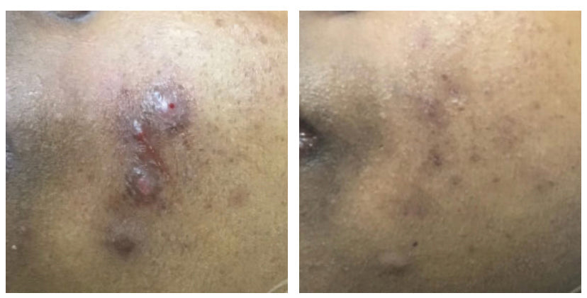 The Bin Pimple Cream and Facewash Combo : Magical Pimple Removal Cream That Makes Acne Disappear!